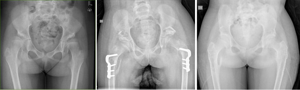 Bäcken och lårbens osteotomi